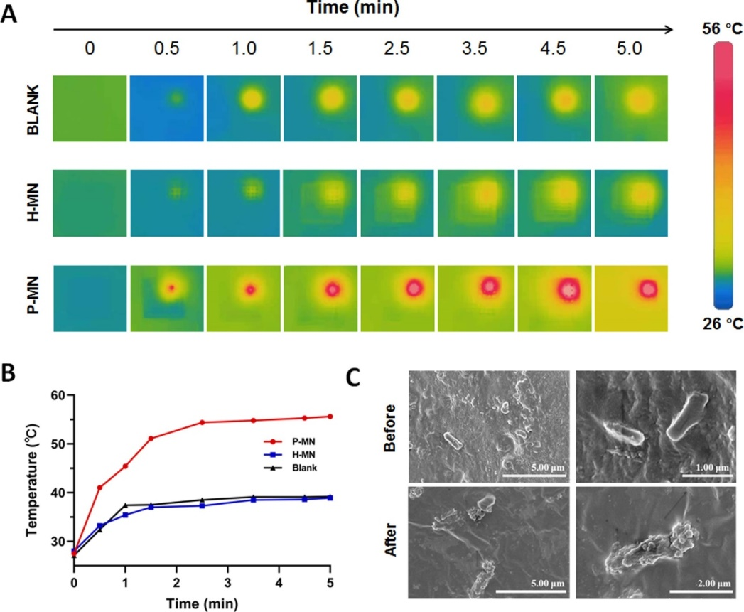 微针(MN)贴片上细菌的光热消融图